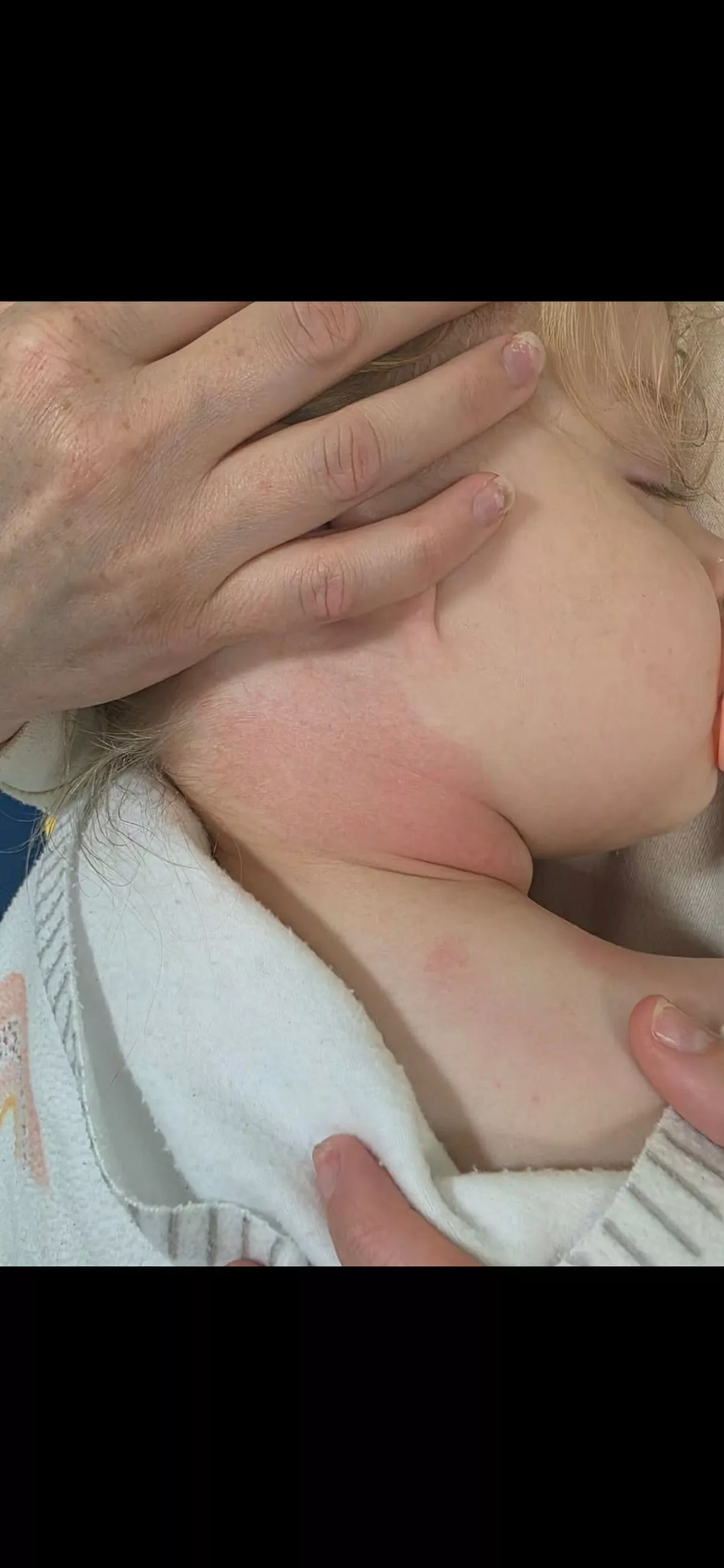 The lump on Delilah's neck