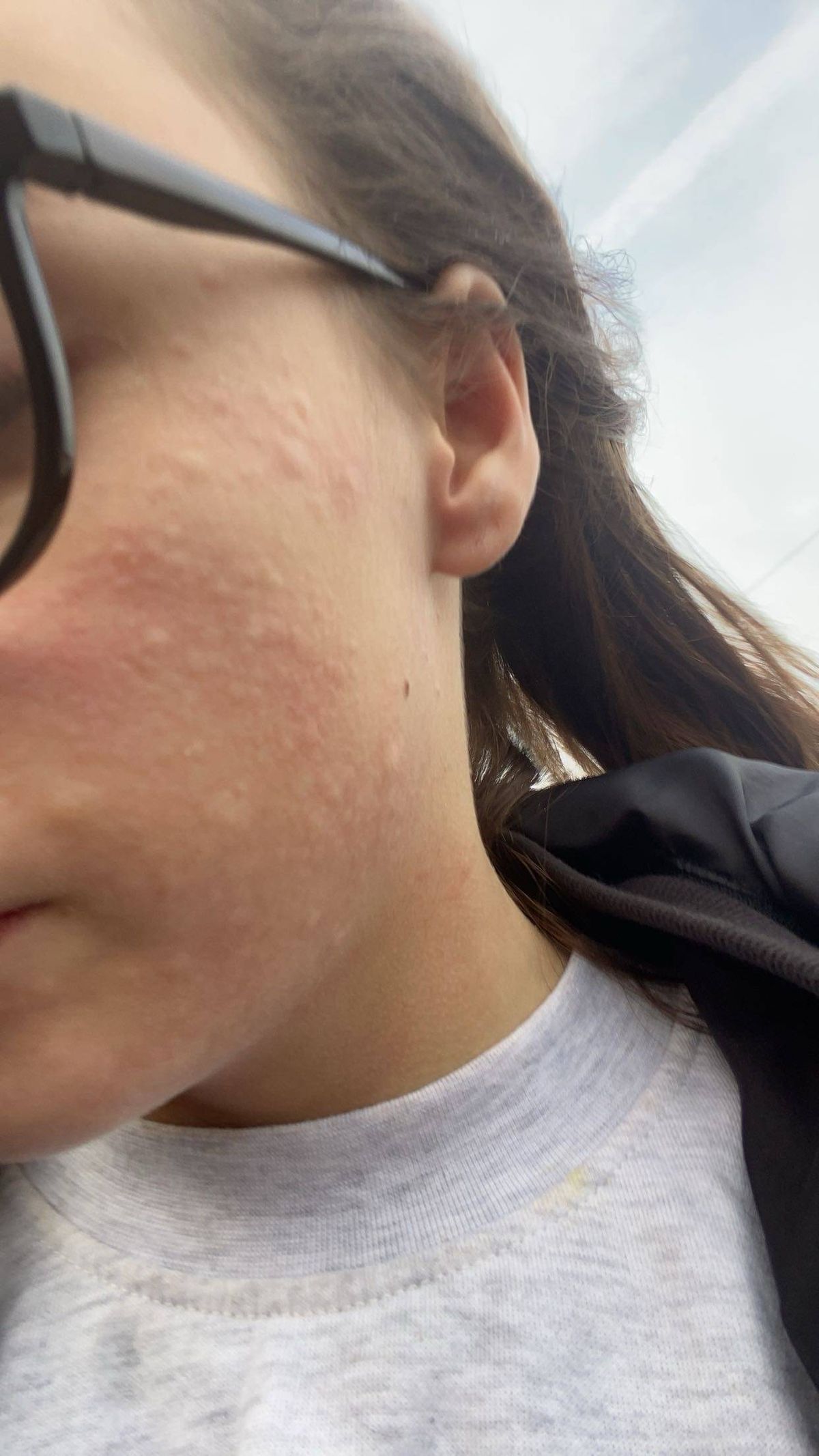 Hives on side of face