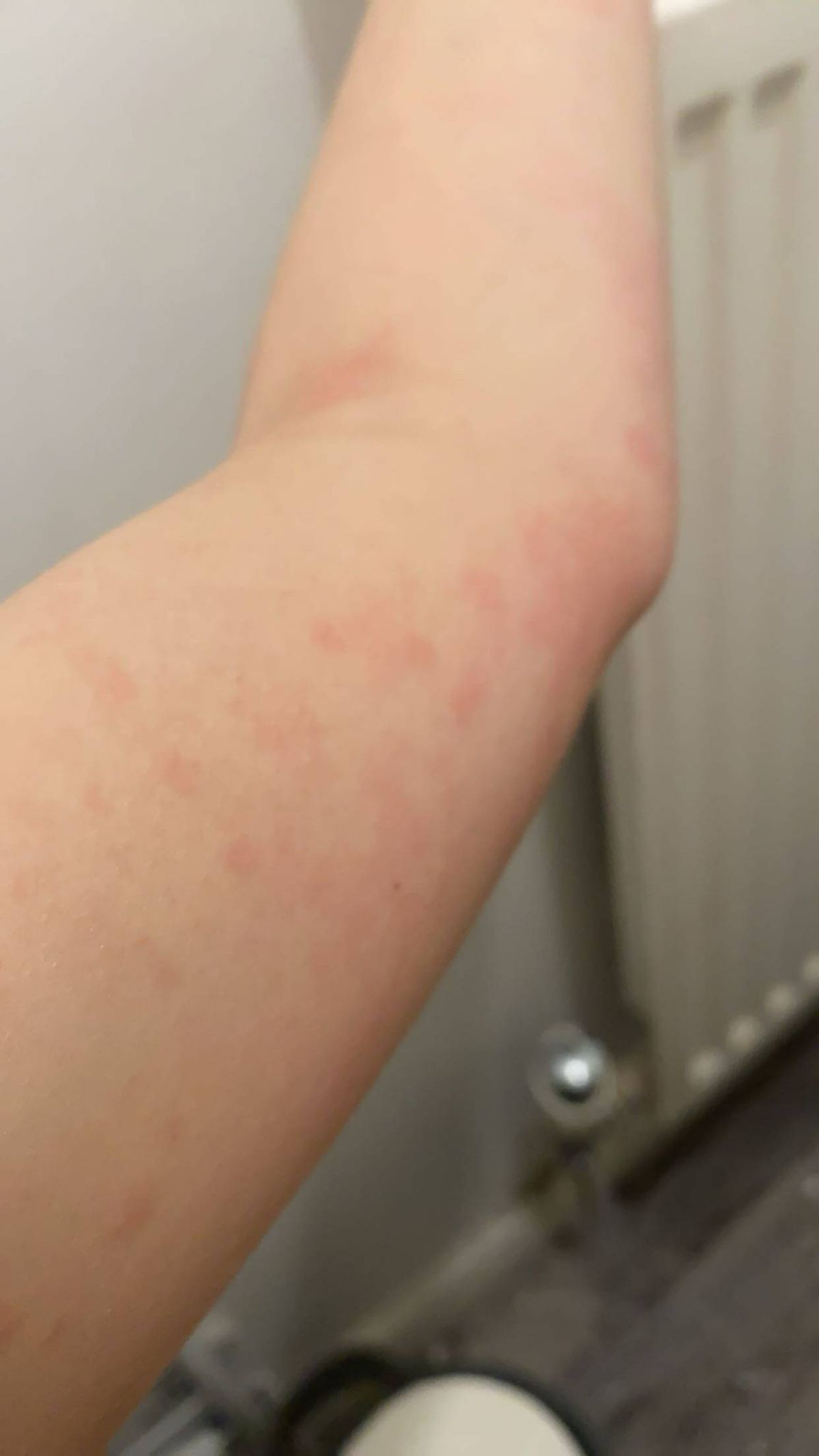 The image shows hives on her skin all up her arm which are red in colour and look blotchy