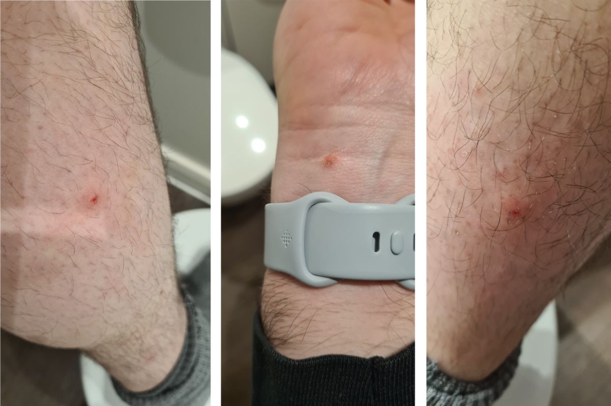 The flea bites sustained by James Alexander during his stay at the hotel