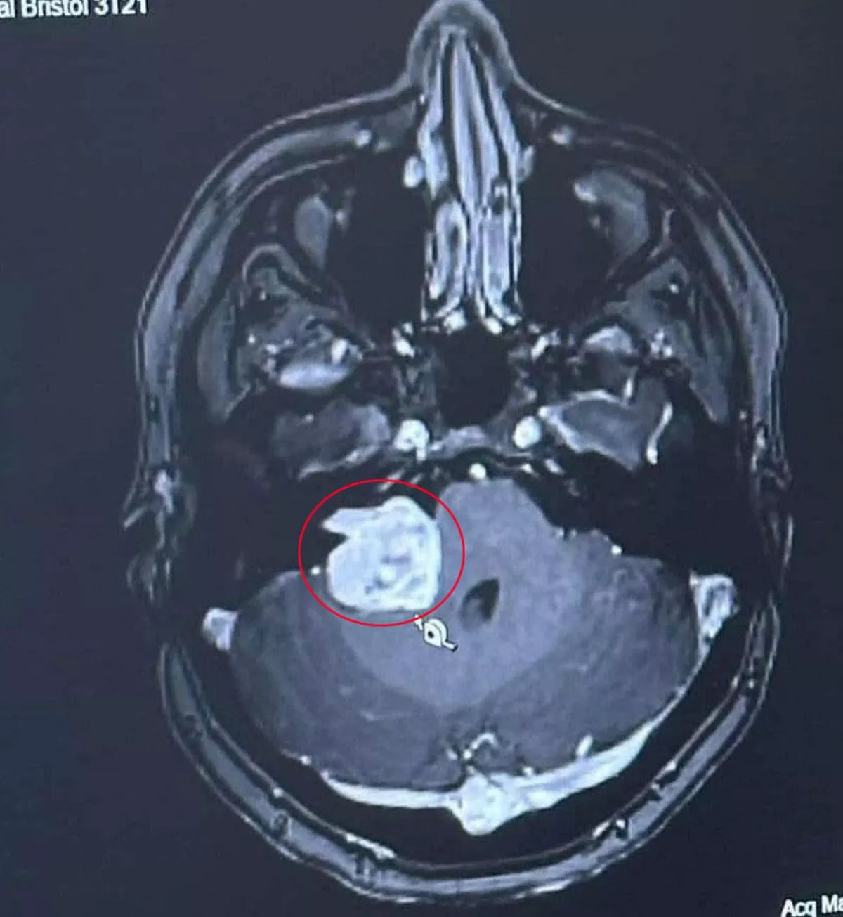 Within days of her diagnosis, Amy underwent emergency brain surgery to remove the 6cm tumour.