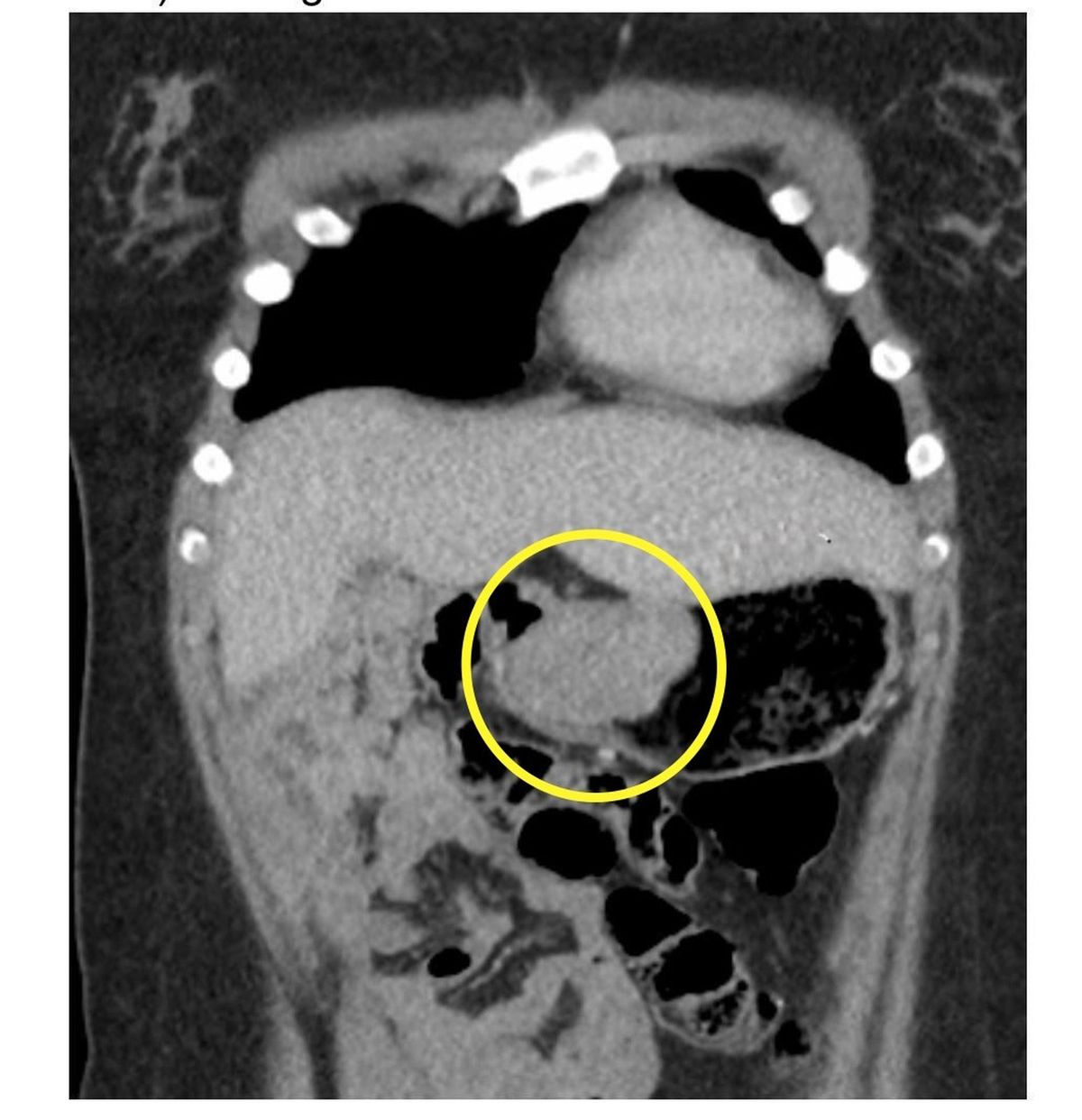 Scans found Bella had a 6cm tumour in her stomach