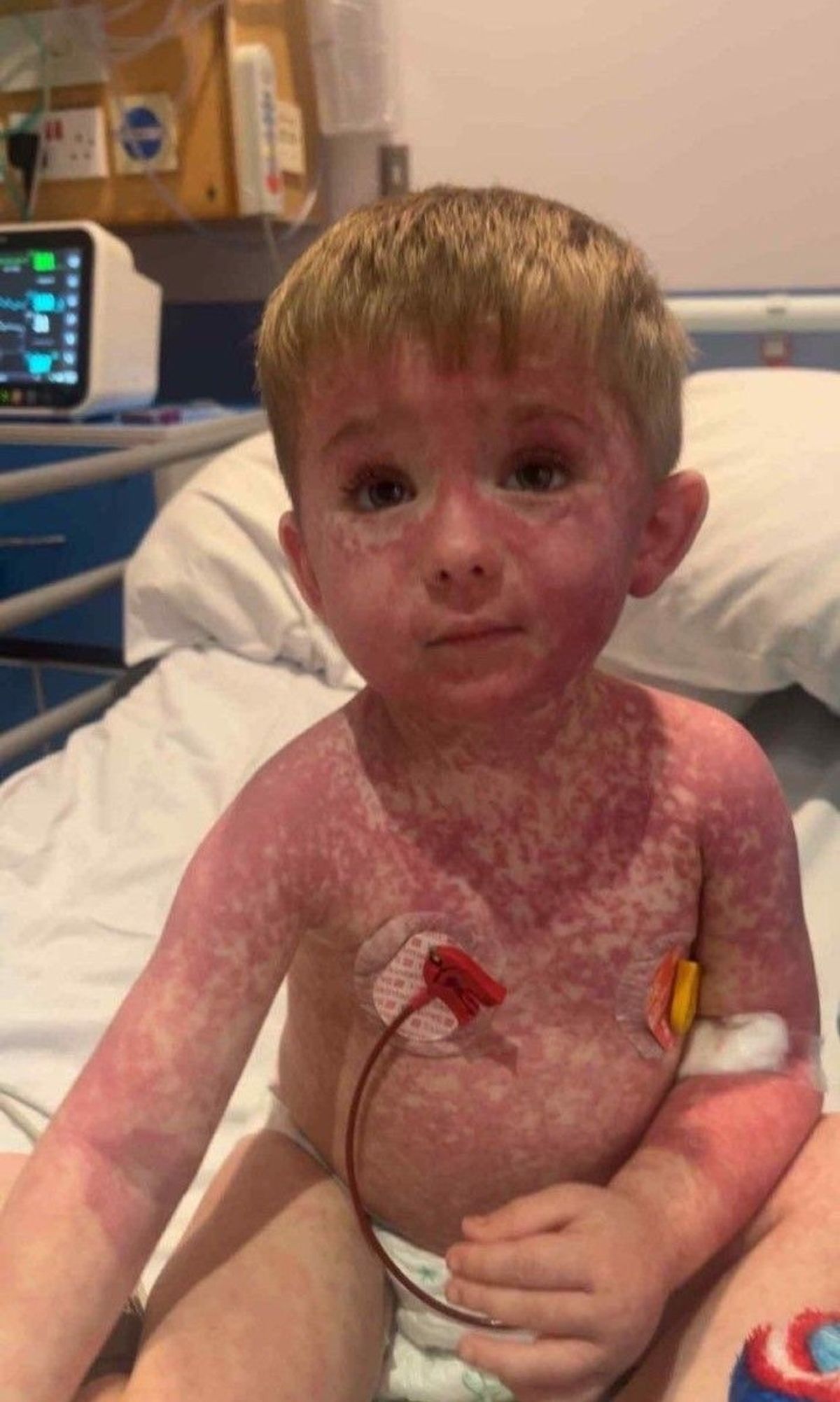 A boy of three sitting in a hospital bed, covered in a red rash