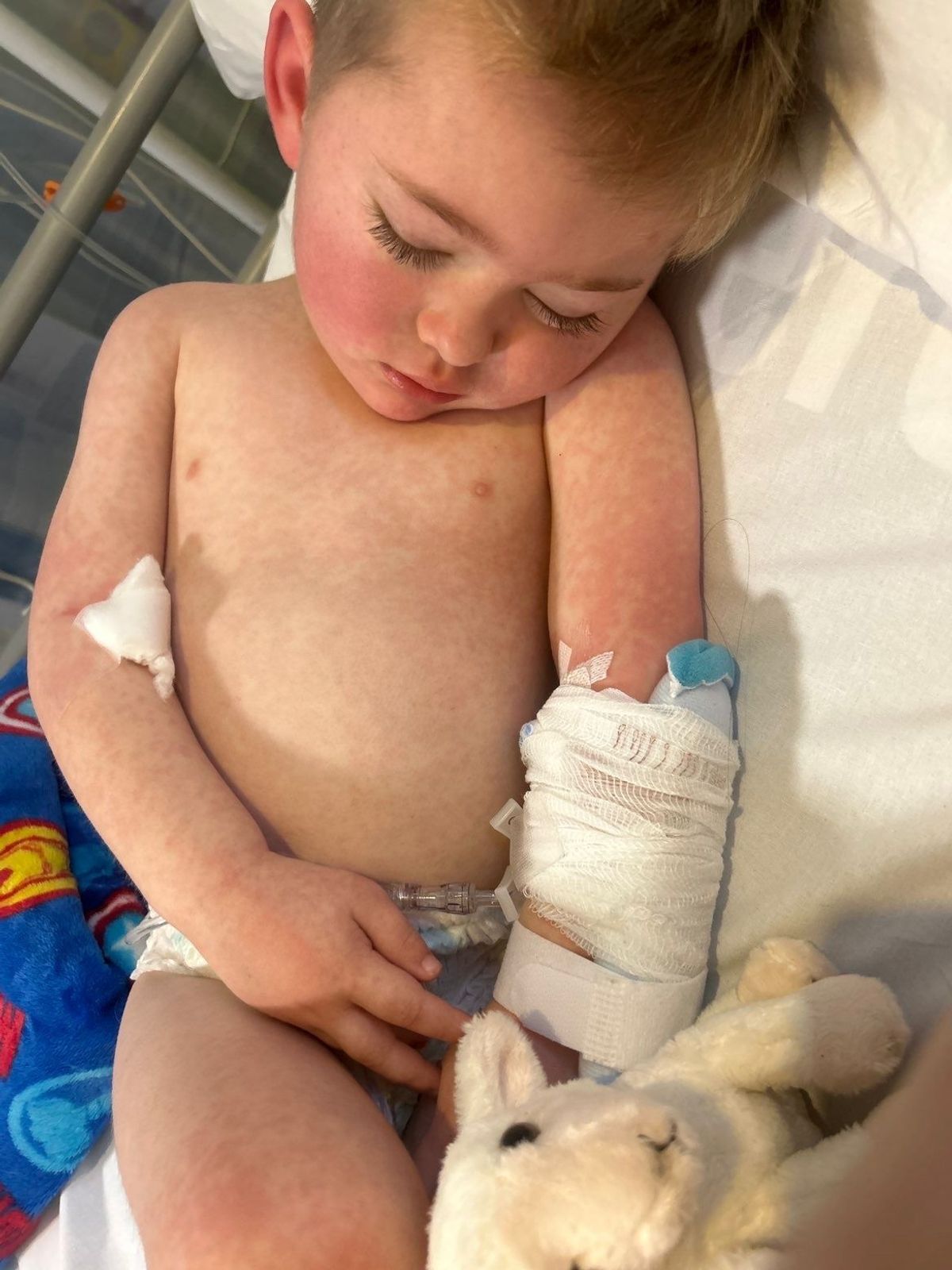 A young boy of three, lying in a hospital bed, sleeping