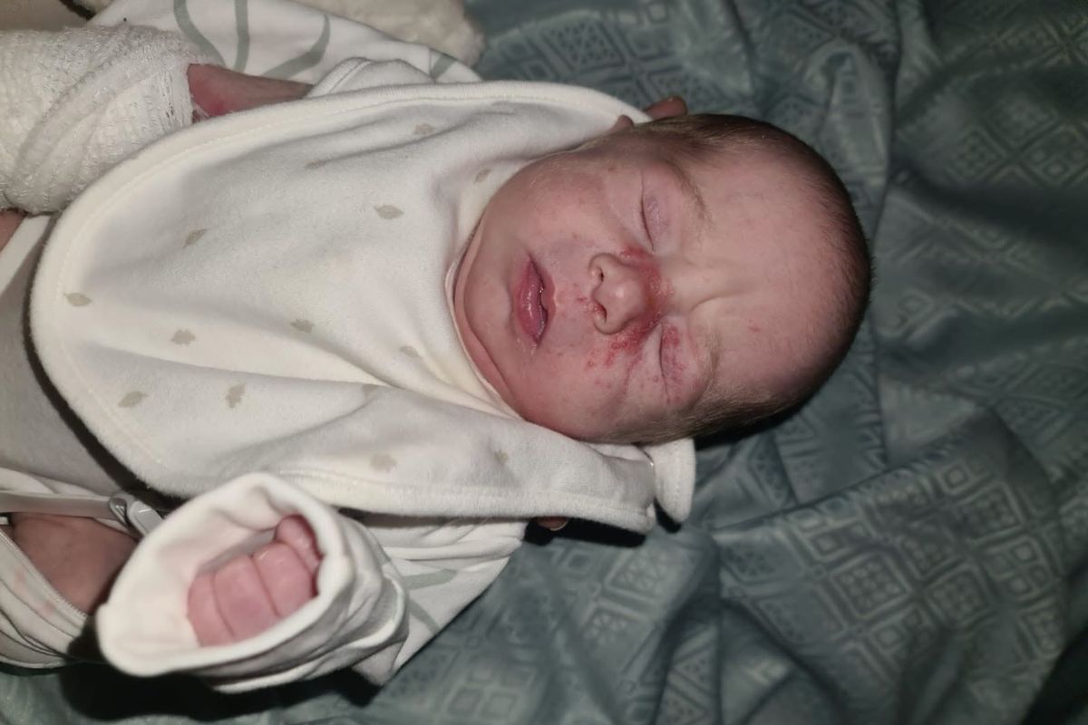 Baby Olivia Barry became dangerously ill after contracting the HSV virus early in her life 