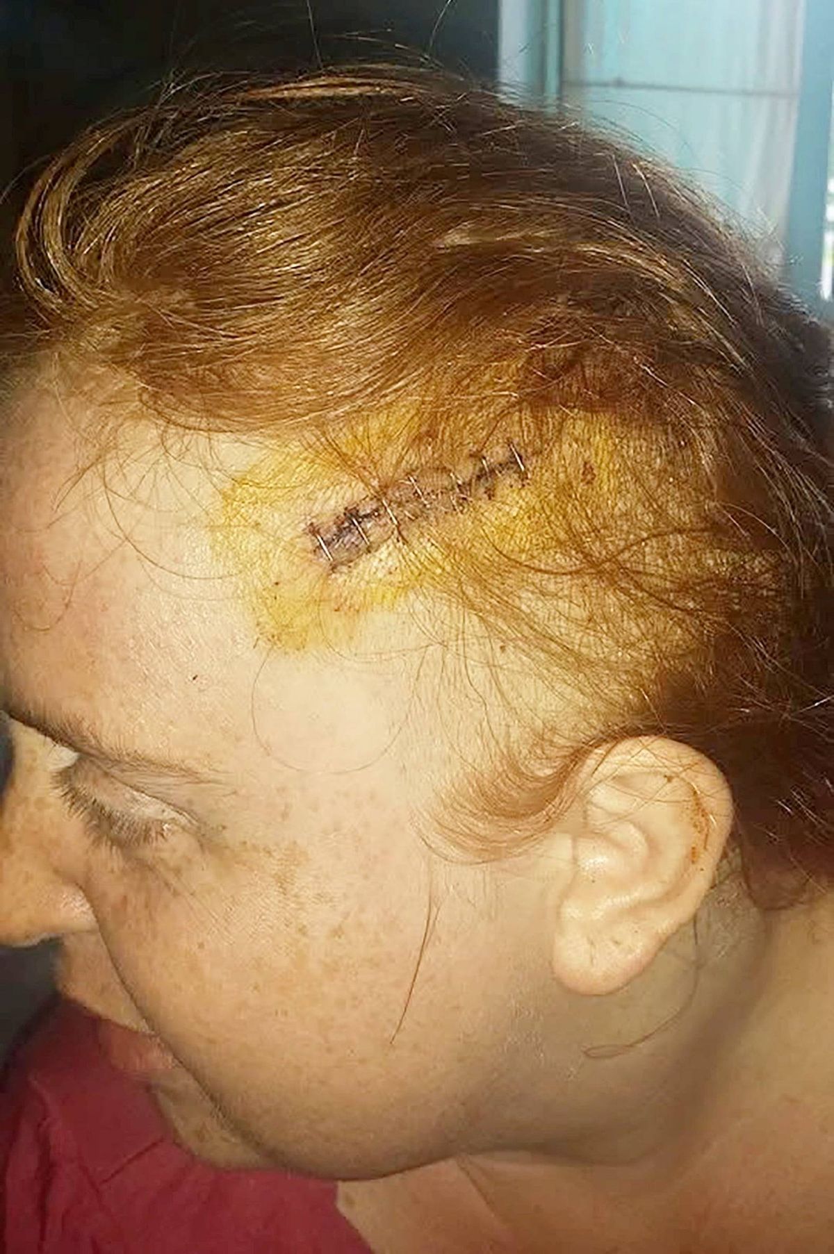 An individual with reddish hair is shown from a side view, with a visible surgical scar on the top of their head. The scar is marked with a distinct line and appears to be in the process of healing, with some discoloration and minor swelling. The person is wearing a red shirt and is looking downward, possibly focusing on something off-camera.