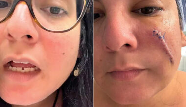 Woman Says She Felt ‘Pretty Good’ After Surgery to Remove Cancerous Mole on Her Face — Until She Took Bandage Off (Exclusive)