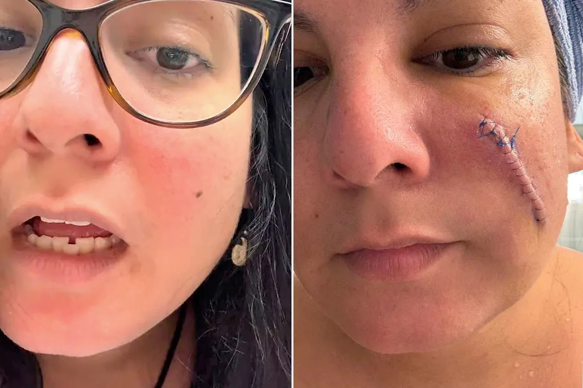 Woman Says She Felt ‘Pretty Good’ After Surgery to Remove Cancerous Mole on Her Face — Until She Took Bandage Off (Exclusive)