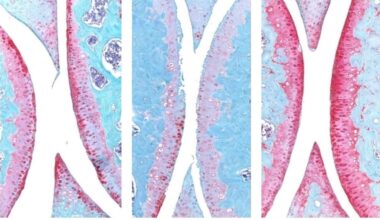 Anti-Aging Drug Regrows Knee Cartilage in Major Breakthrough That Could End Knee Replacements