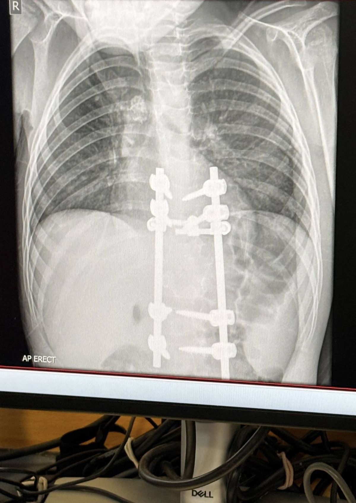 An x-ray image displayed on a computer monitor, showcasing a skeletal structure with a prominently visible surgical implant.