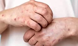 Kasaragod ಜಿಲ್ಲೆಯಲ್ಲಿ 32 ಮಂದಿ ಕುಷ್ಠ ರೋಗಿಗಳು