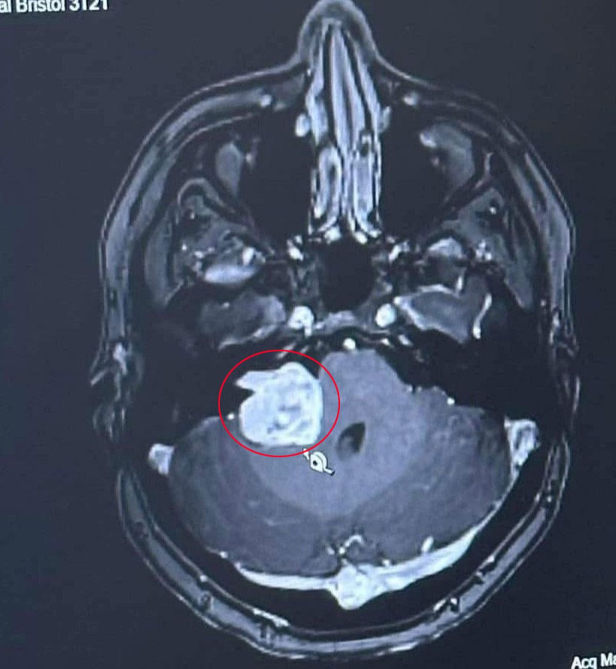 Within days of her diagnosis, Amy underwent emergency brain surgery to remove the 6cm tumour.