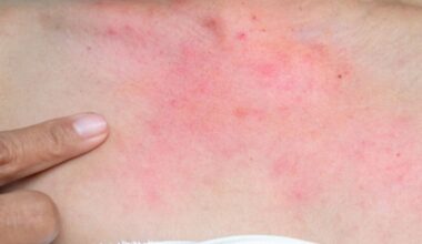 Warning of cold allergy that leaves itchy red spots