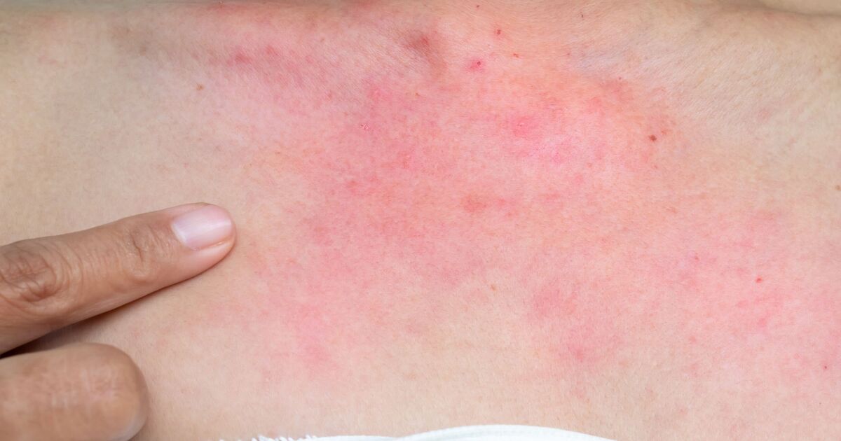 Warning of cold allergy that leaves itchy red spots