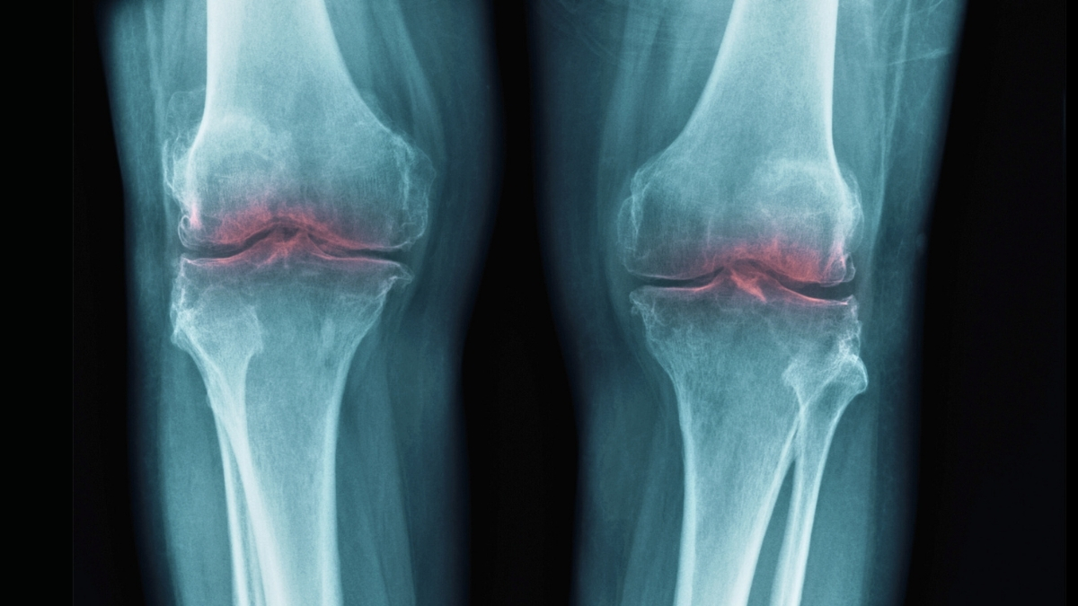 New Breakthrough to Restore Aging Joints Could Help Treat Osteoarthritis : ScienceAlert