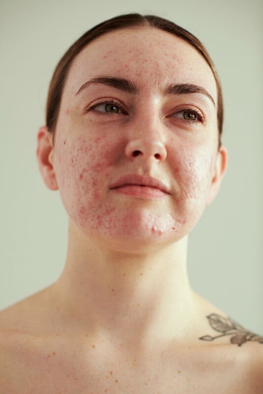 A woman with light skin and brown hair pulled back looks off-camera. Her face has visible acne and redness. She has a slight smile and a floral tattoo is partially visible on her shoulder. The background is plain and neutral.