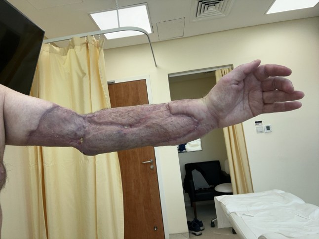 WARNING, GRAPHIC CONTENT - Story from Jam Press (Flesh Eating Bug) Pictured: Mark?s arm caused by flesh-eating disease. Flesh-eating disease eats away fitness fanatic dad-of-three's arm?after sore throat A flesh-eating disease caused by a sore throat ate away a fitness fanatic?s arm. Mark Brooks needed 25 operations to cut away the muscle on his left arm after he was diagnosed with necrotising fasciitis. The 54-year-old blames going to the gym and pulling a muscle in his arm while recovering from a sore throat for the disease developing. ?I was fine and completely healthy and it came completely out of the blue,? Mark said. ?And then all of a sudden, I?m fighting for my life. It was ridiculous. ?I had the worst sore throat I?d ever had. ?Then I went to the gym and did an intense workout." Mark of Grimsby, Lincs, also told?NeedtoKnow: ?I was also fasting so I think that paved the way for the illness. ?While I was working out, I tweaked my elbow which was no big deal. ?Then I developed a fever so I slept like a champion. ?When I woke up, it felt like I?d smashed my elbow really hard on the bedside table. It was killing and I couldn?t use it. ?After that, I developed a fever and started puking like a champion. ?I thought it was bad luck that I had a bad elbow, a sore throat and food poisoning. ?I remember sitting on the carpet thinking that my decision making capacity was diminishing and that I only had one good decision left in me.? The dad-of-three went to hospital and medics assumed he had compartment syndrome, a painful condition from dangerous pressure buildup in a muscle compartment. But he was rushed into surgery when a large bruise appeared out of nowhere. Mark was diagnosed with necrotising fasciitis, or the flesh-eating disease that was eating away his skin and muscle. He had 25 operations to remove the dead skin, brachialis muscle, much of his tricep, a finger flexor and the connective tissue between muscles. The bacteria had also entered his bloodstream, triggering his kidneys to shut down. Mark said: ?I was in ICU for a week. ?They told me I had multi-organ failure. ?That sounded really bad. ?At one point, you could see straight through my arm. ?There was bone with nothing supporting it. ?It was grim to look at.? Mark spent nine weeks in hospital and still has more surgery to come. Doctors used a vacuum pack to keep the limb viable while fighting infection. Skin was later harvested from his leg and back in agonising graft procedures. He said: ?The donor sites were worse than the arm. ?I woke up in the worst pain of my life, crying uncontrollably. ?They removed a muscle from my back and swung it around to rebuild my arm. ?Then they removed fat from my stomach and packed it into my arm to support the exposed bone. ?If I?d gone to an orthopaedic surgeon, they would have amputated. ?One different decision, one different hospital, and my life would be totally different.? The cost of reconstruction has already reached around ?450,000, covered by insurance, with tens of thousands more expected. Mark says he developed PTSD since the ordeal in December 2023. He added: ?The antidote was gratitude. ?Thinking about what I still had, not what I?d lost.? ?Necrotising fasciitis has a mortality rate of around 20 per cent ? but in my case it was closer to 50% so I?m just thankful to be alive and have all my limbs. ?Hopefully, by telling this story, it saves someone else?s life.? ENDS