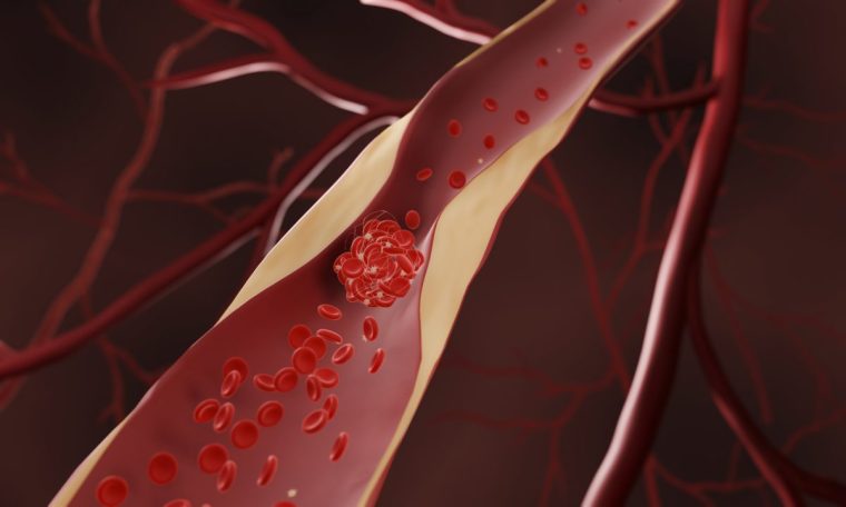 Blood clot forming in a narrowed artery