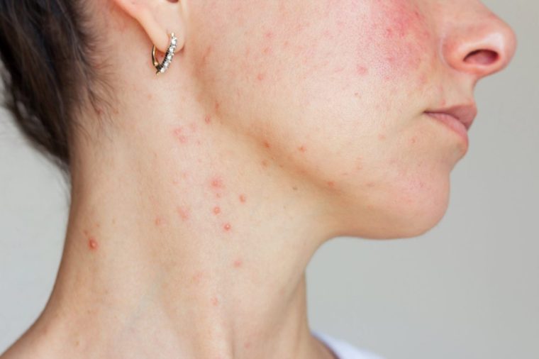 A young woman with rosacea and acne