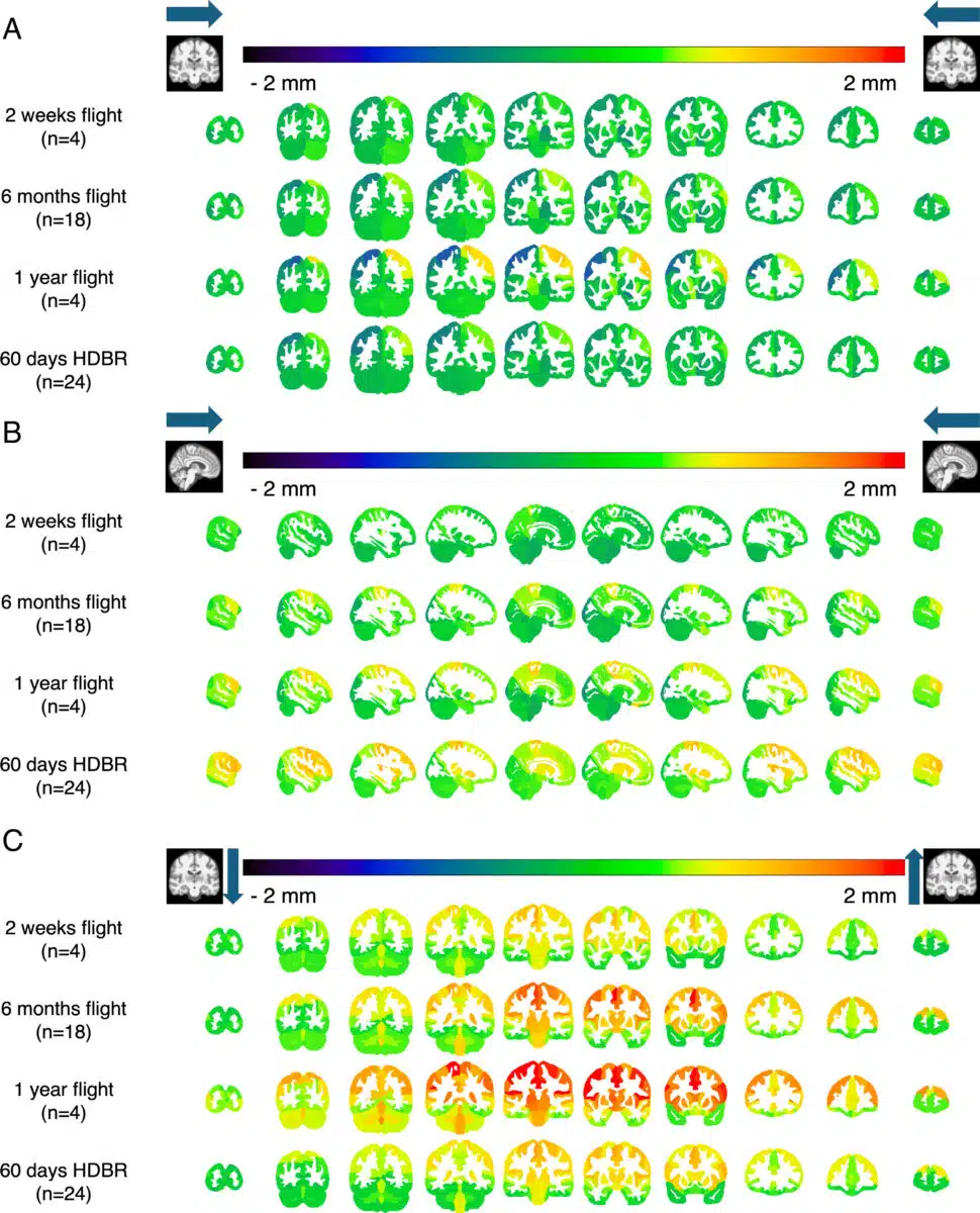 Visualization Of Brain Displacement In Astronauts After Different Durations Of Spaceflight.
