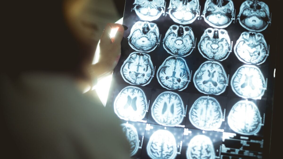 Youngest UK Dementia Case Dies at 24