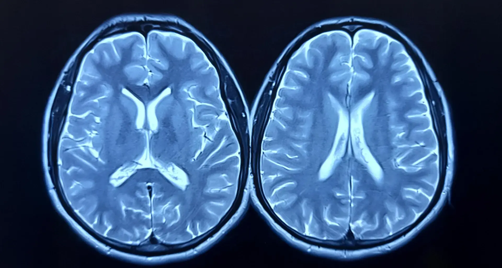 MRI scans show exercise can make the brain look younger