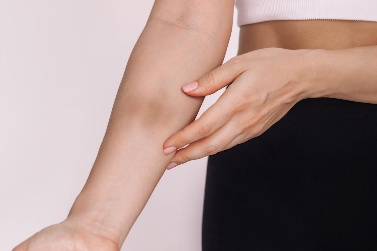 Close-up shot of a woman holding out a bruised arm