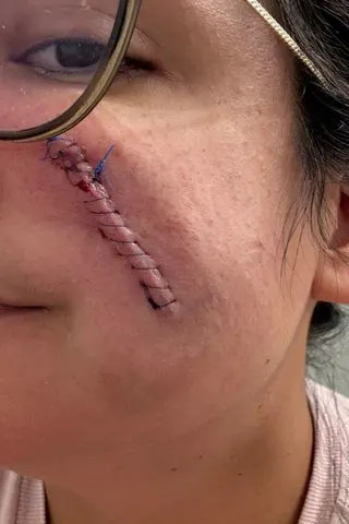 Daniela Mullins Daniela Mullins after surgery.