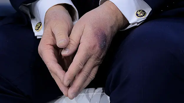 Trump Says Heavy Bruise On Hand Came After He 'Clipped It' On Table