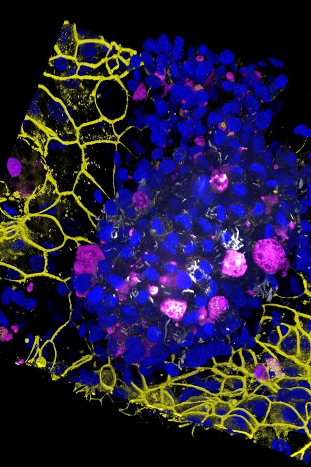 lung-on-a-chip infected by TB bacteria