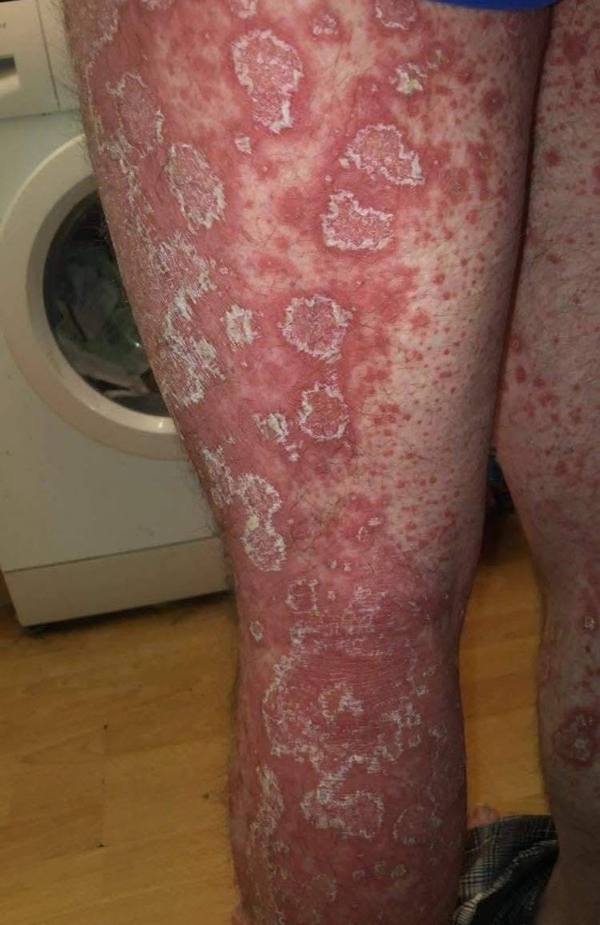 Jonathan Haigh, 42, has suffered from severe Pityriasis rubra pilaris (PRP) for five years 