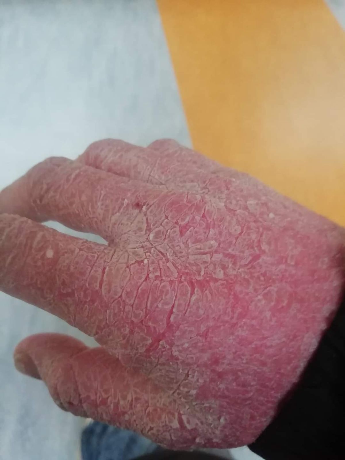 Pityriasis rubra pilaris (PRP) a rare skin condition that causes redness and scaling of the skin