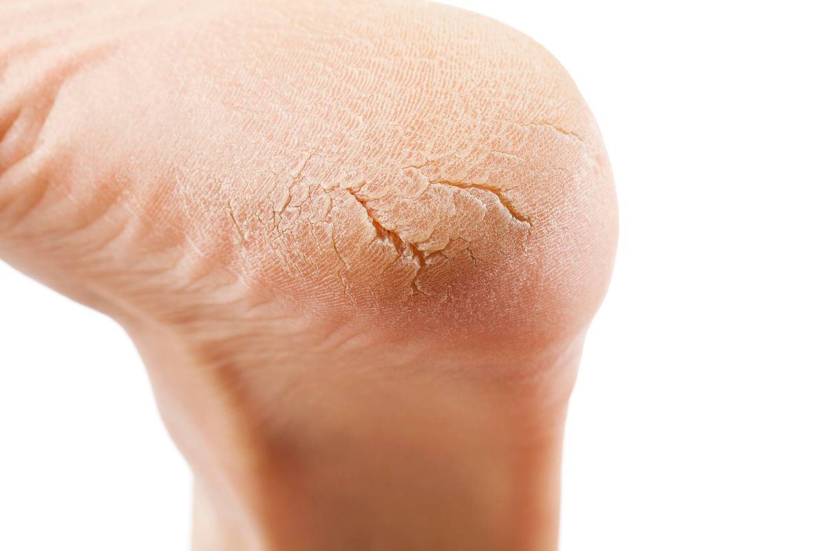 A close-up view of a knee showcasing a prominent, dry, and cracked patch of skin. The image is set against a plain white background, emphasizing the texture and condition of the skin.