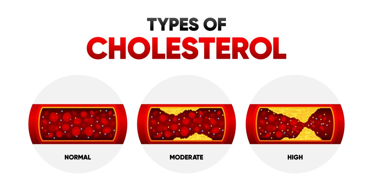 Types Cholesterol. LDL and HDl level. Arteriosclerosis, infarct, ischemia, thrombosis disease. Cholesterol in human blood vessels. Vector illustration