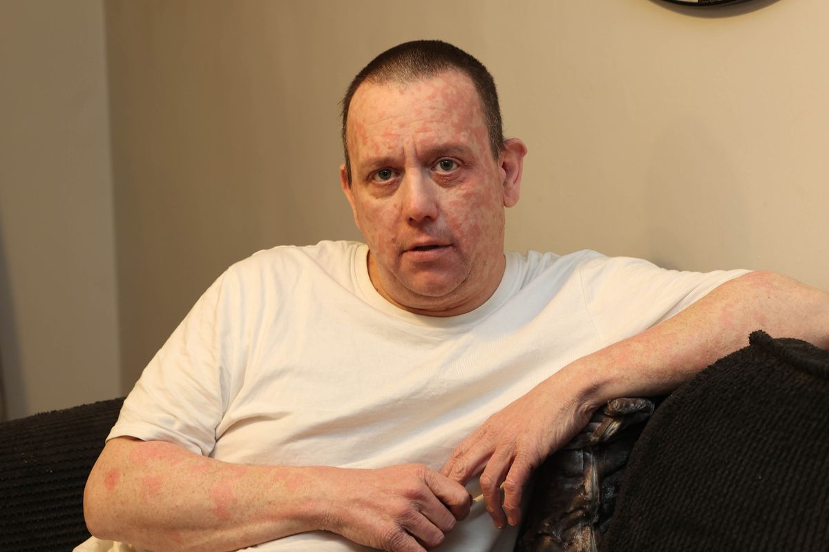 Jonathan Haigh, 42, father of three battling with rare skin condition