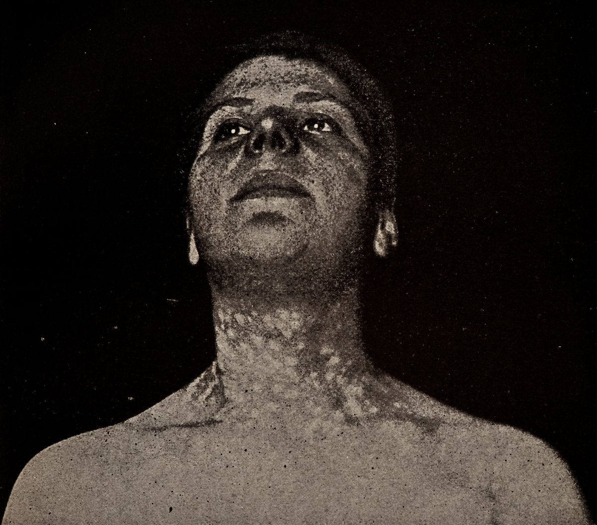 Photograph of a Syphilis patient from 'Atlas of Syphilis and the Venereal Diseases' by Frank Mracek and Lemuel Bolton Bangs, 1898