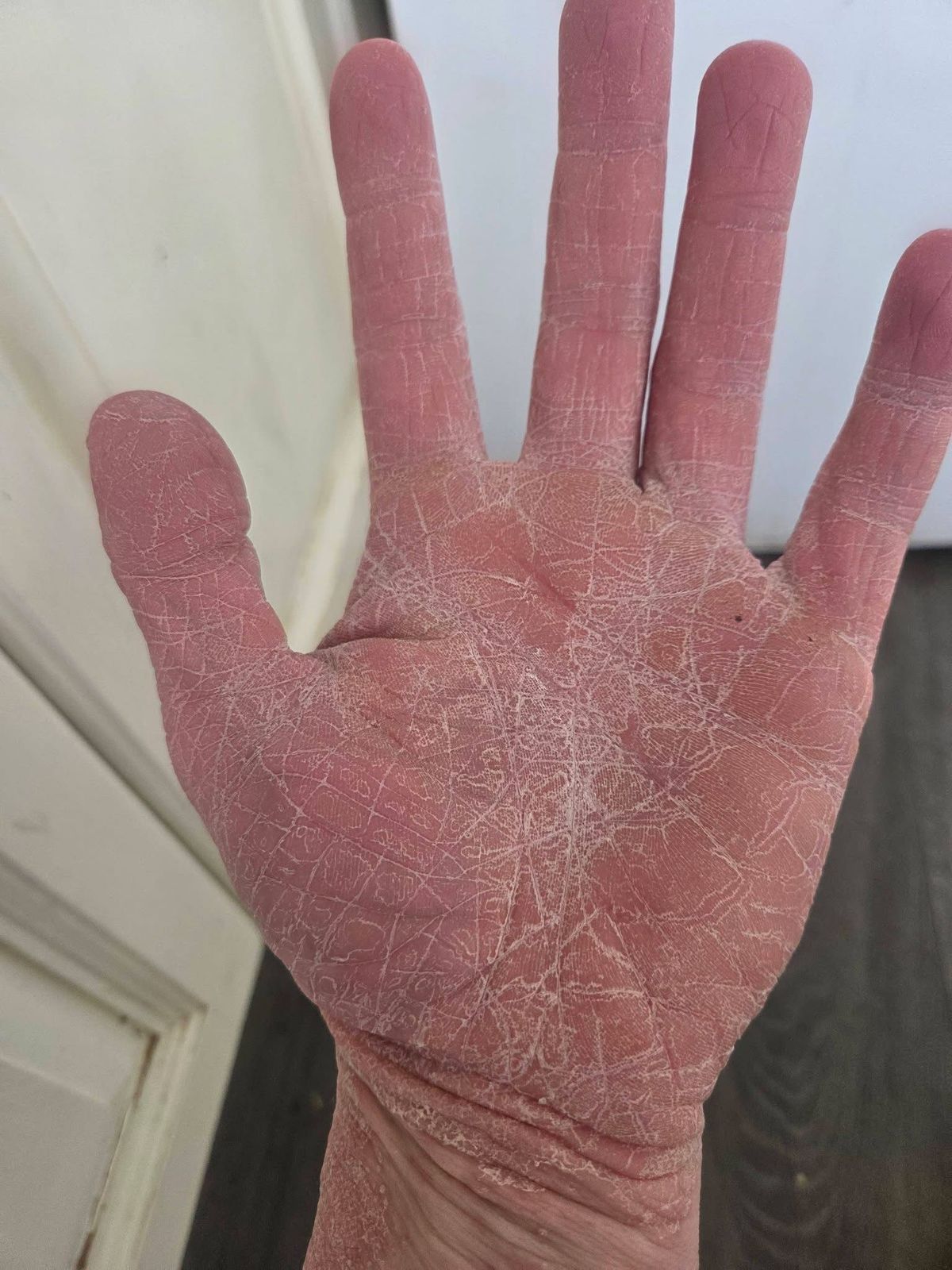 Jonathan Haigh, 42, has suffered from severe Pityriasis rubra pilaris (PRP) for five years 