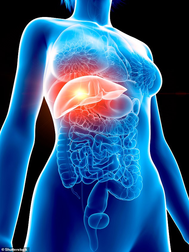 The British Liver Trust estimates that 80 per cent of those with fatty liver disease are undiagnosed as there are often no symptoms in the early stages