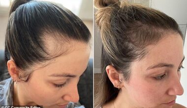 A Vida Glow customer whose hair began to reappear after treatment (right)