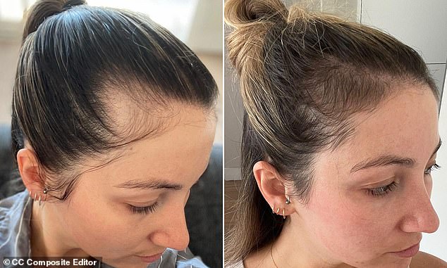 A Vida Glow customer whose hair began to reappear after treatment (right)