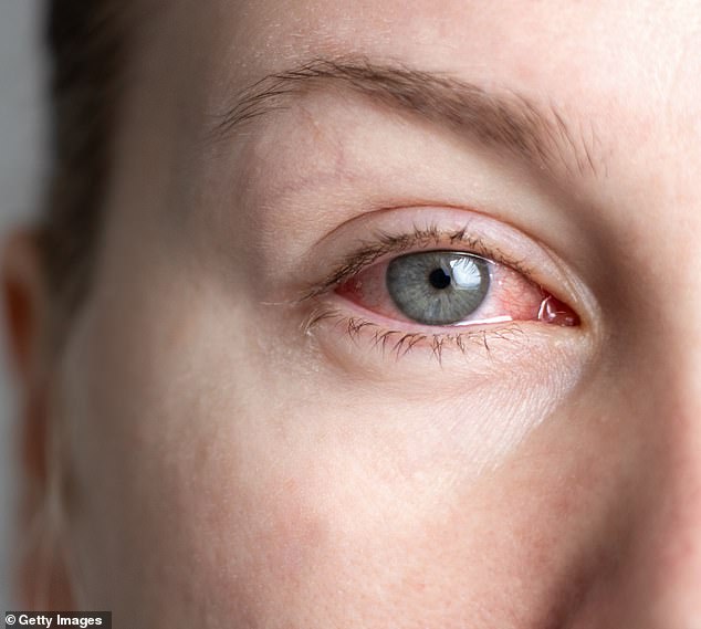 Allergies such as hay fever are another cause of red eyes – but typically occur alongside itching