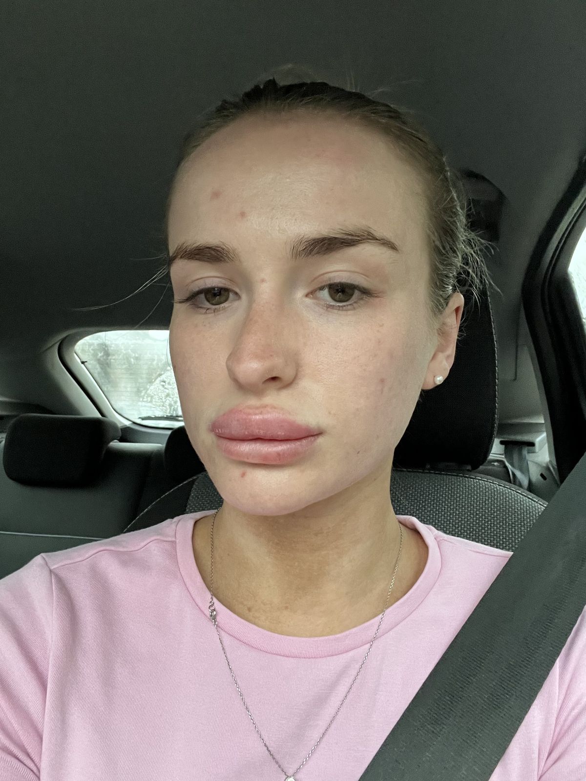PIC FROM Kennedy News/@lilythompstone (PICTURED: LILY THOMPSTONE, 23, WOKE UP TO FIND HER LIPS HAD SWELLED UP) A woman claims her entire body broke out in a horrific rash due to the STRESS of doctors not taking her illness seriously. Lily Thompstone said she has 'always' suffered with gut issues and was often sick after meals but doctors put it down to IBS and she was continually left in 'discomfort'. Things took a sudden when the 23-year-old woke up with 'humongous' lips in May 2023 and rushed to A&E where she was given steroids to bring down the swelling. DISCLAIMER: While Kennedy News and Media uses its best endeavours to establish the copyright and authenticity of all pictures supplied, it accepts no liability for any damage, loss or legal action caused by the use of images supplied and the publication of images is solely at your discretion. SEE KENNEDY NEWS COPY - 0161 697 4266