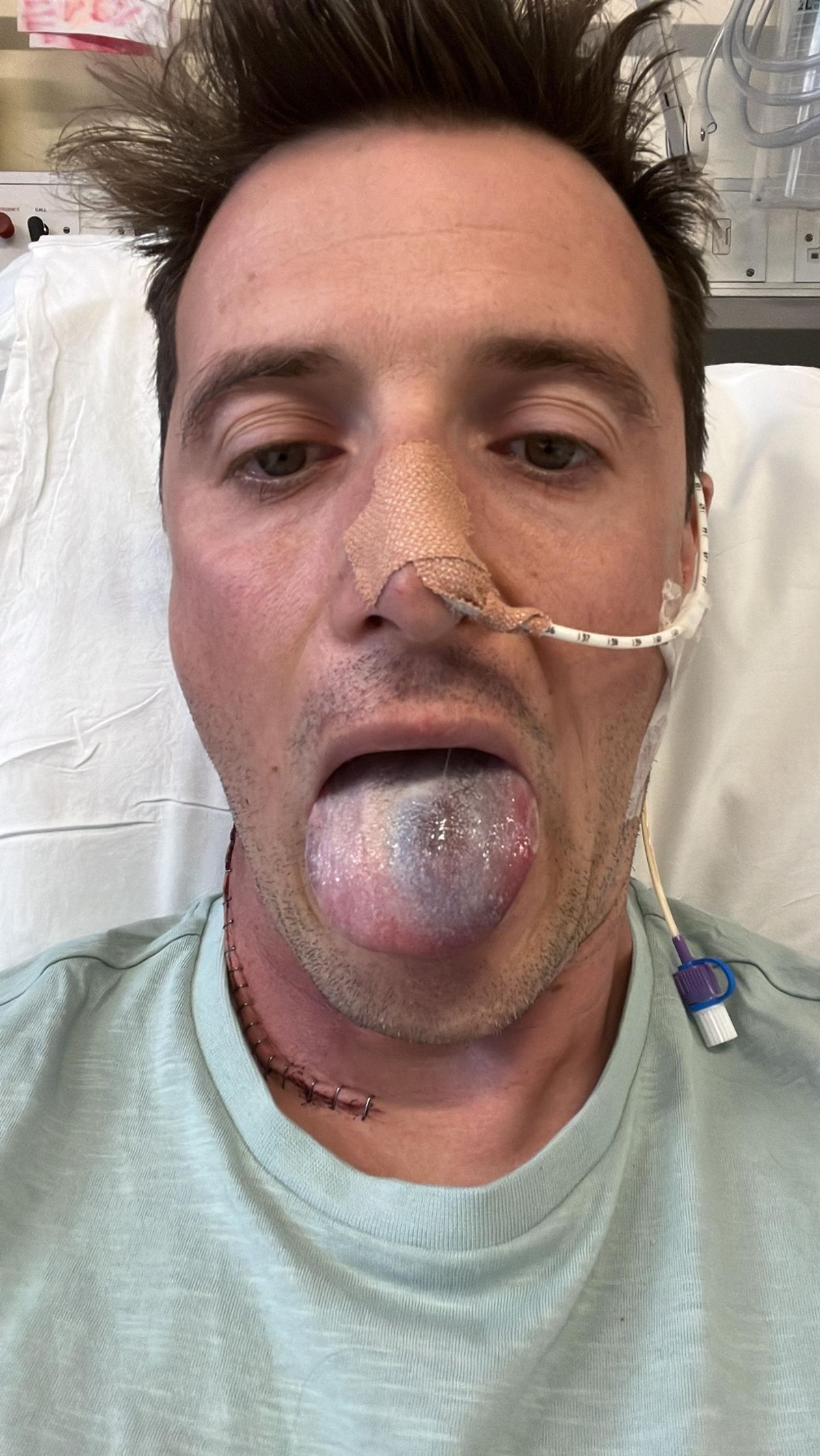 A man undergoing head and nexk cancer treatment stickimg out is tongue