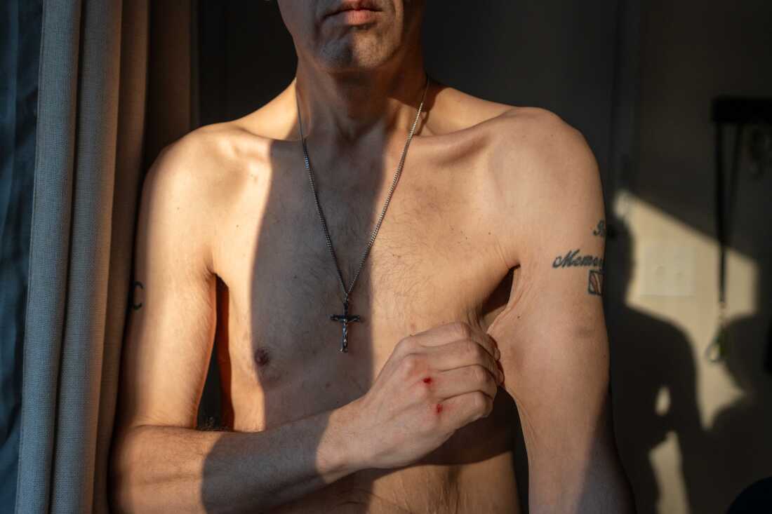 Jason Krynicki's torso is shown not wearing a shirt. He is a thin man and is pulling at the skin of his arm.