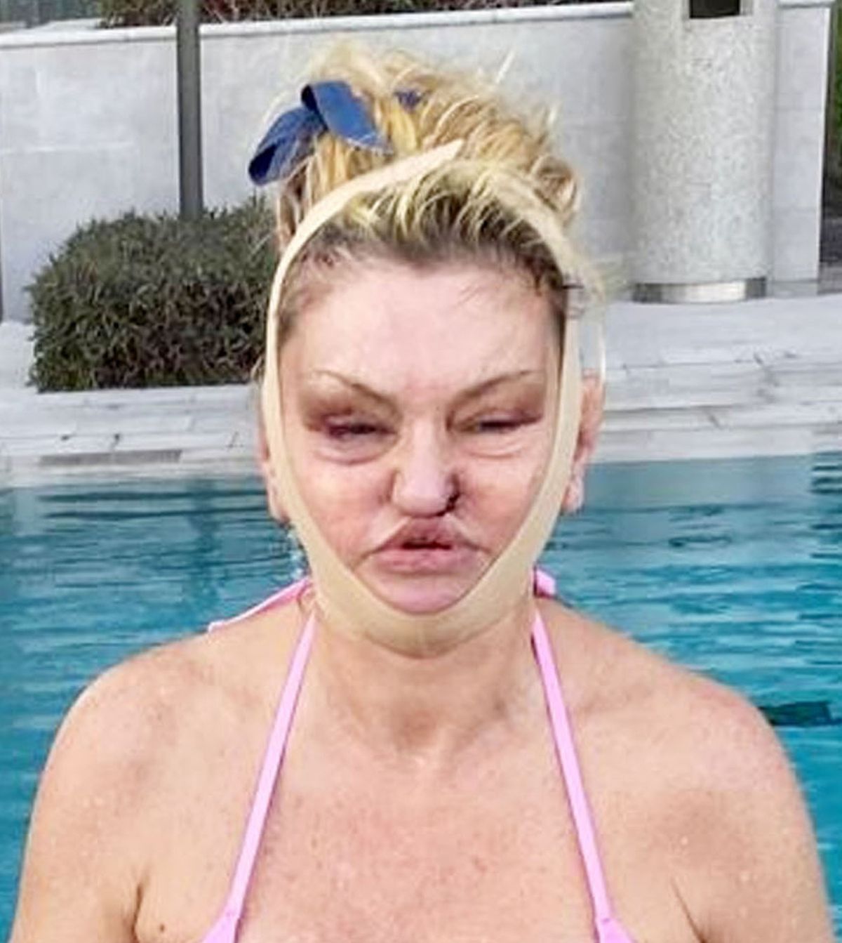 Danniella's facial surgery was on full display