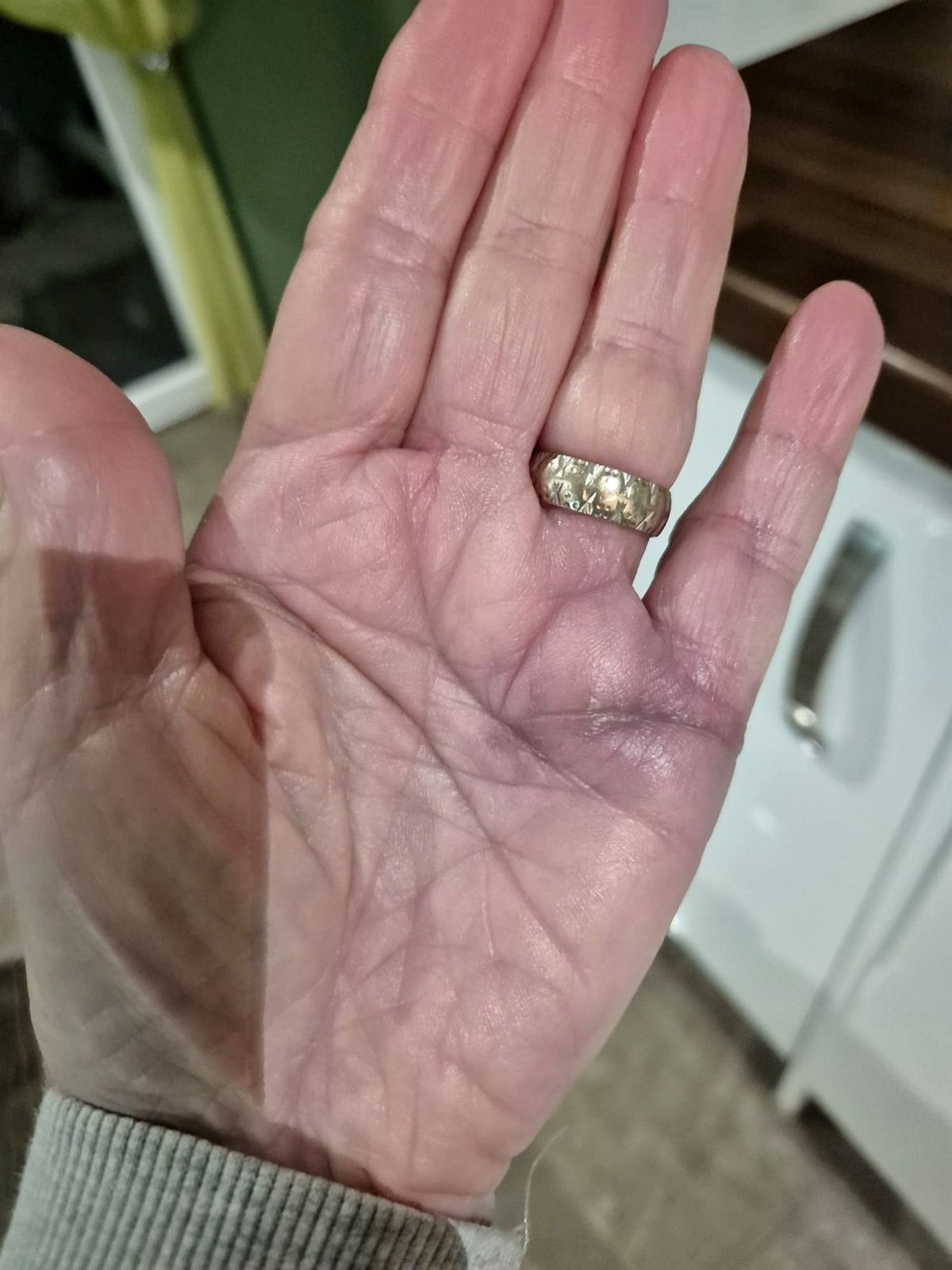 Elizabeth Palmby's injured hand - with a visible scar