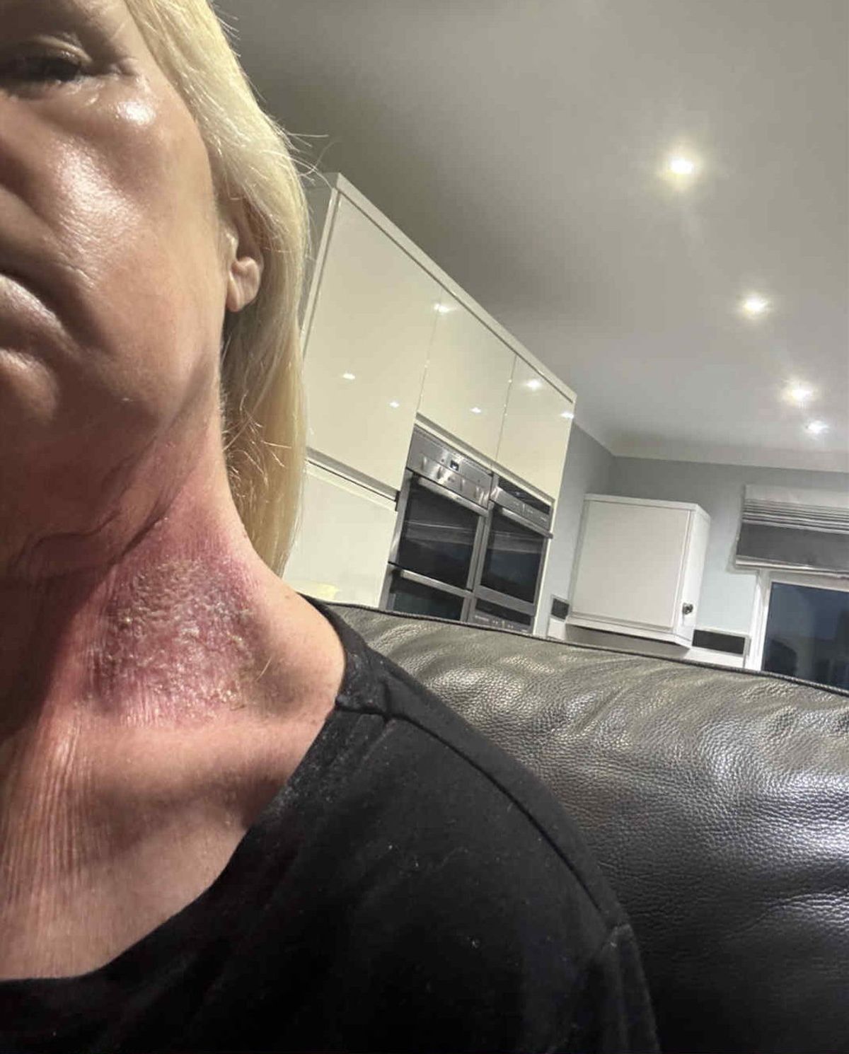 After lymph nodes were taken out