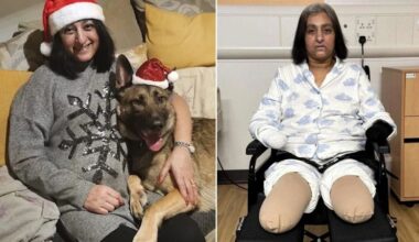 A routine dog lick, 2 days later Punjabi-origin woman in UK was in coma, all limbs removed