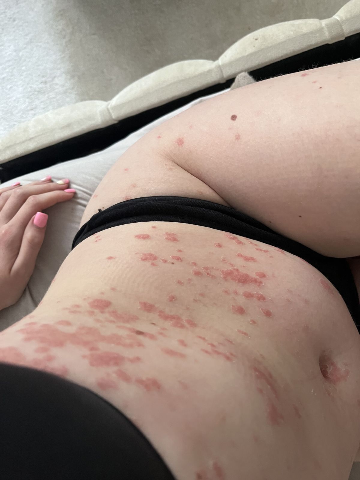 PIC FROM Kennedy News/@lilythompstone (PICTURED: LILY THOMPSTONE'S RASH COVERING MOST OF HER BODY) A woman claims her entire body broke out in a horrific rash due to the STRESS of doctors not taking her illness seriously. Lily Thompstone said she has 'always' suffered with gut issues and was often sick after meals but doctors put it down to IBS and she was continually left in 'discomfort'. Things took a sudden when the 23-year-old woke up with 'humongous' lips in May 2023 and rushed to A&E where she was given steroids to bring down the swelling. DISCLAIMER: While Kennedy News and Media uses its best endeavours to establish the copyright and authenticity of all pictures supplied, it accepts no liability for any damage, loss or legal action caused by the use of images supplied and the publication of images is solely at your discretion. SEE KENNEDY NEWS COPY - 0161 697 4266