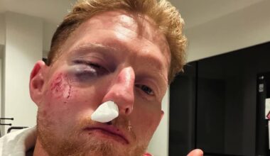 Ben Stokes suffers facial injuries after being hit by cricket ball